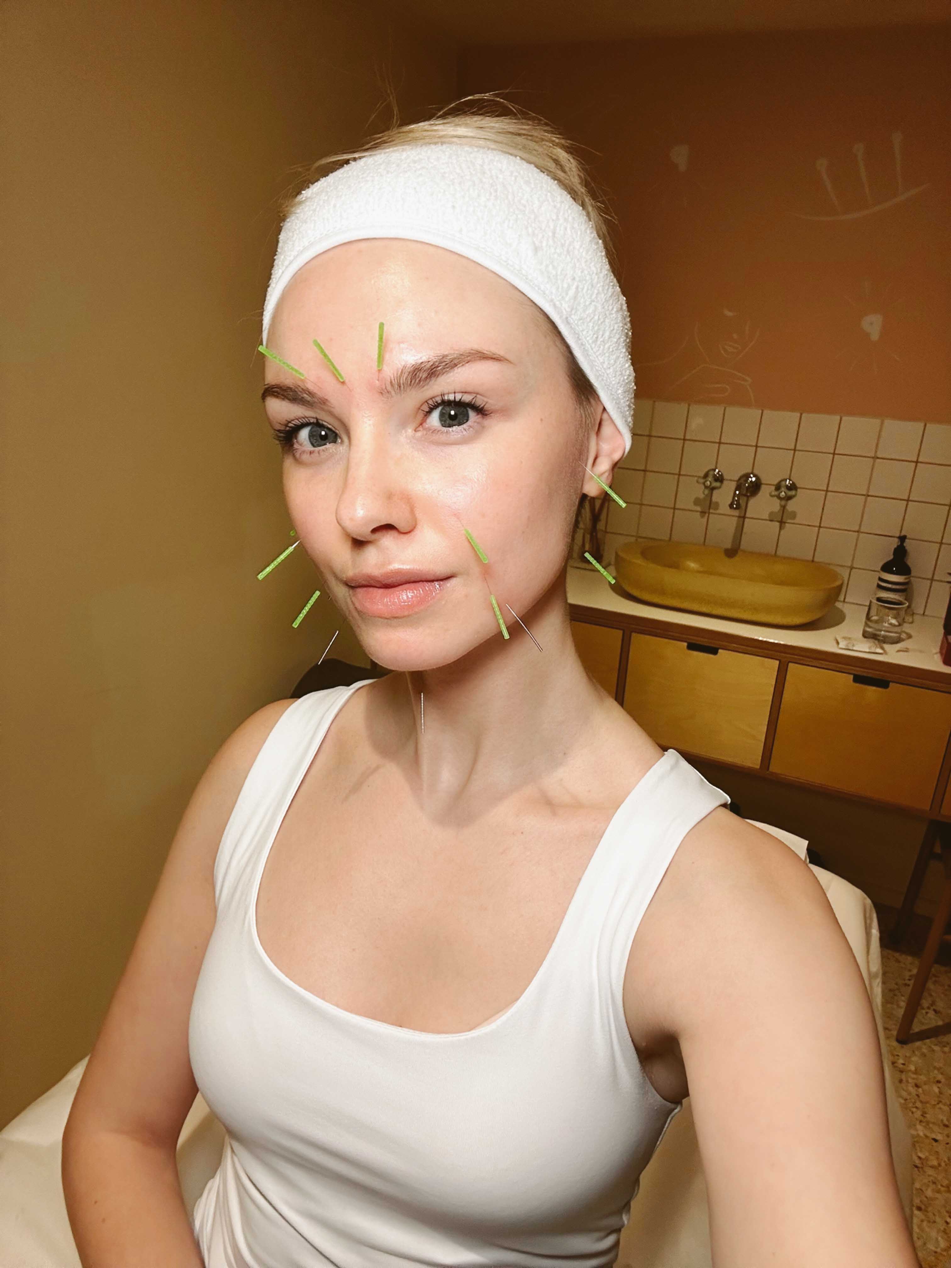 Facial acupuncture; the key to looking younger