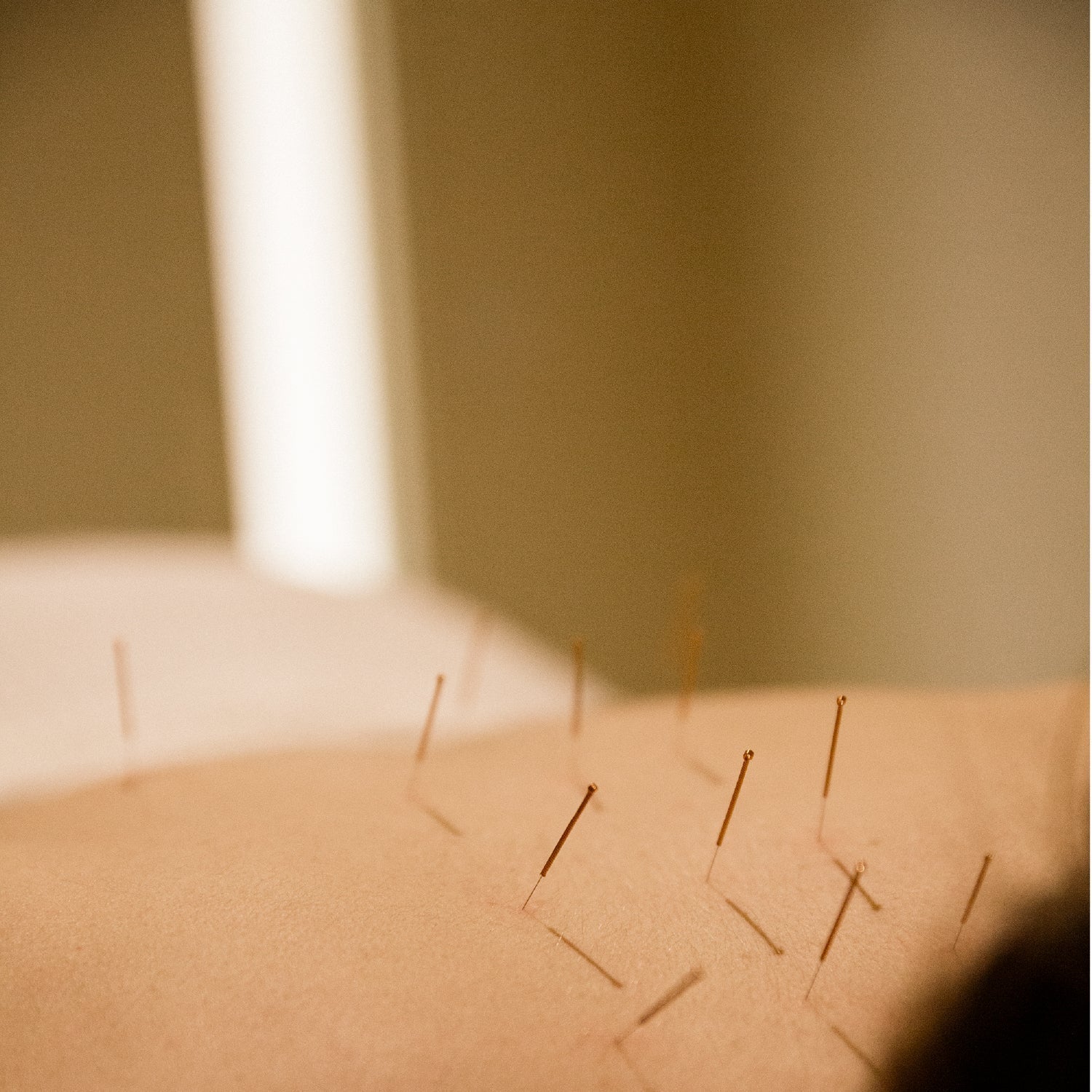Acupuncture for sciatica