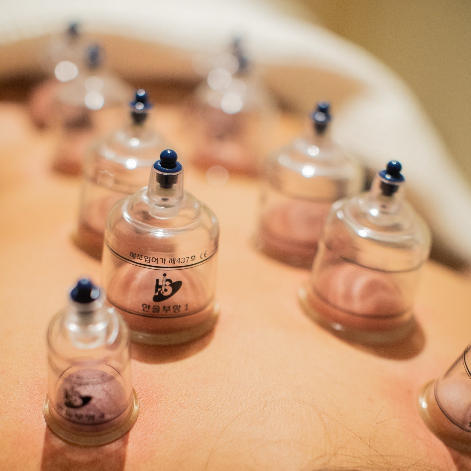 What are the benefits of cupping therapy?