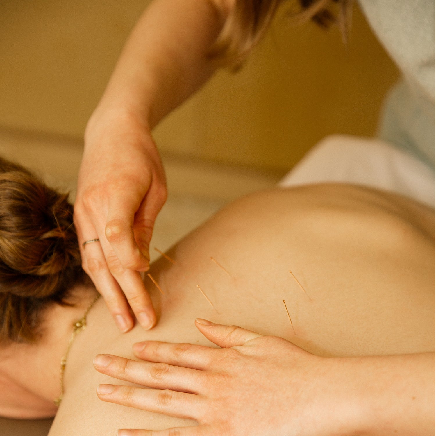 Acupuncture for muscle knots and tension; does it work?