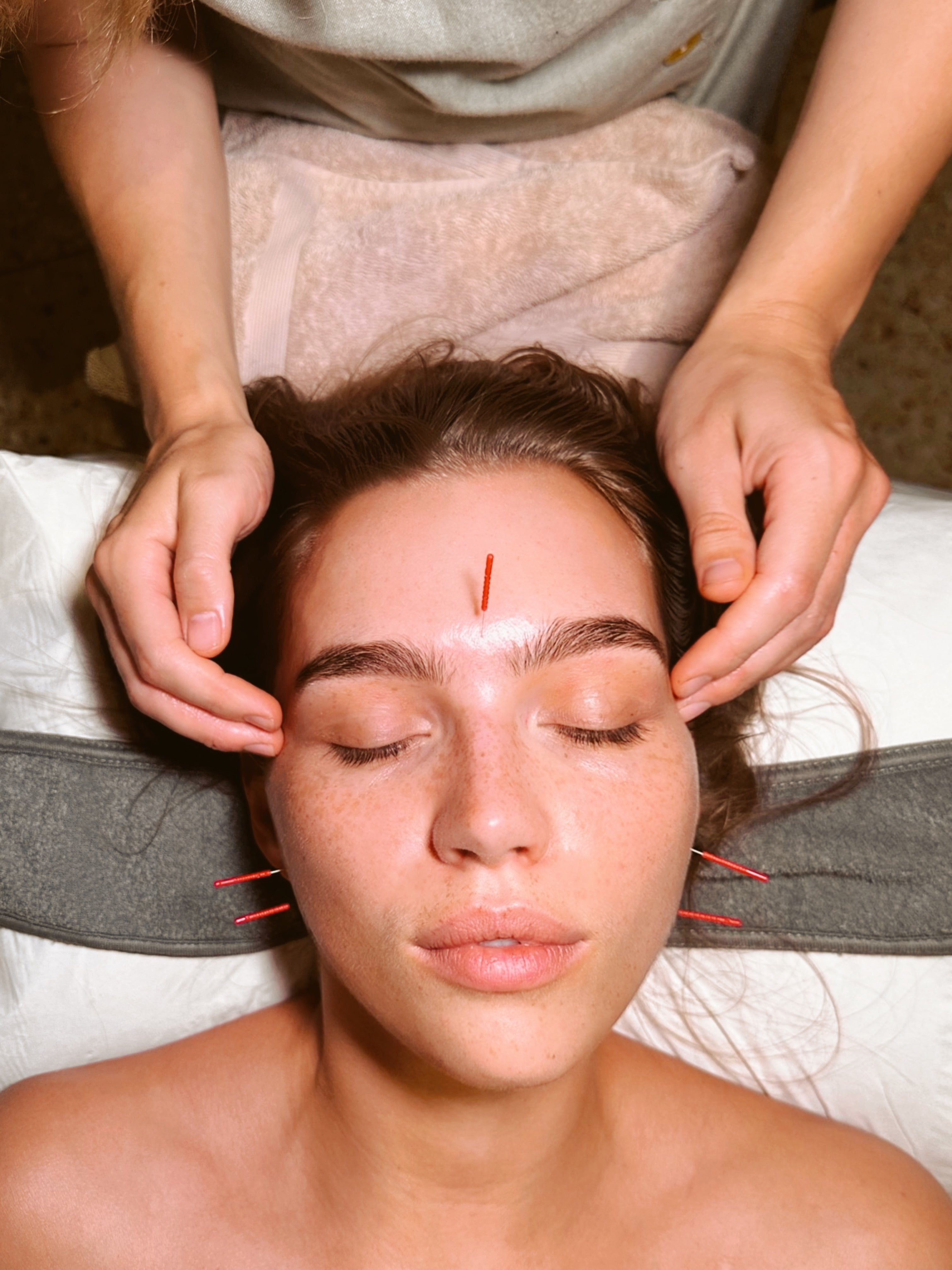 How acupuncture helps reduce chronic migraines